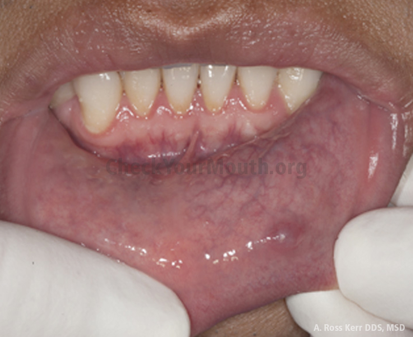 purple spots in mouth